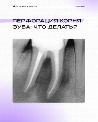 Спасаем зубы с перфорацией канала.